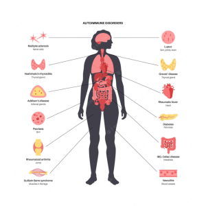 Endometriosis Autoimmune Disease