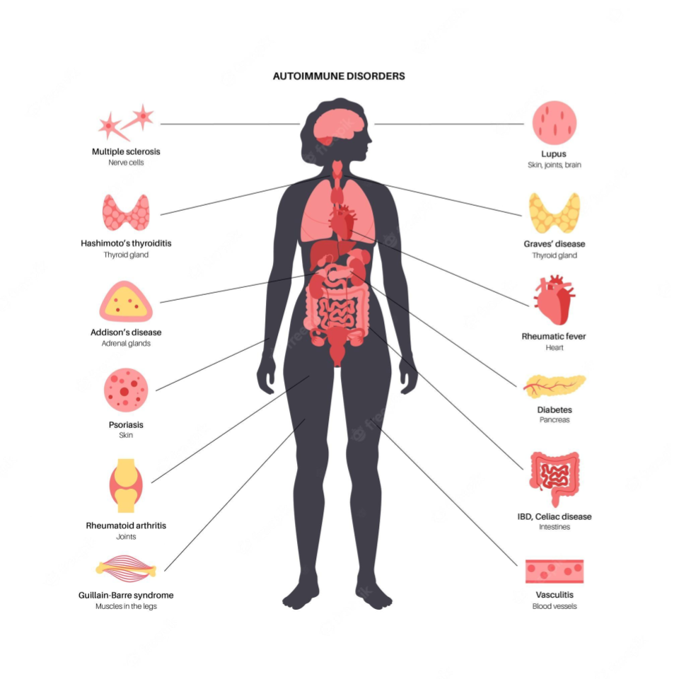 Endometriosis Autoimmune Disease