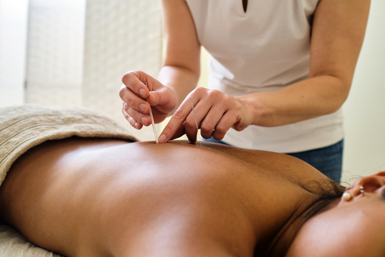 Acupuncture: An Underexplored Solution for Endometriosis Pain