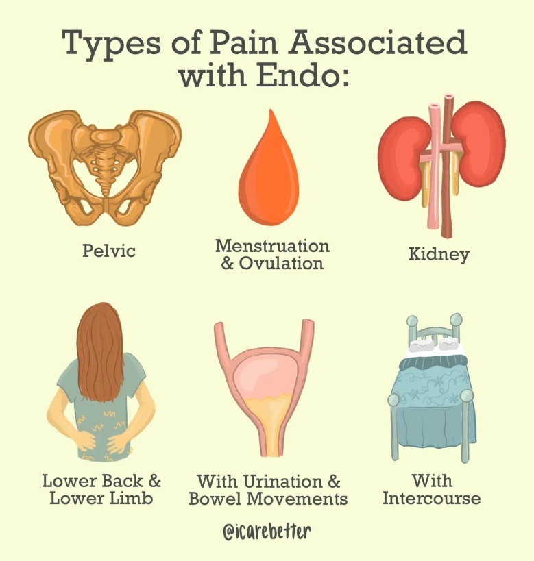 Type of Pain Associated with Endometriosis